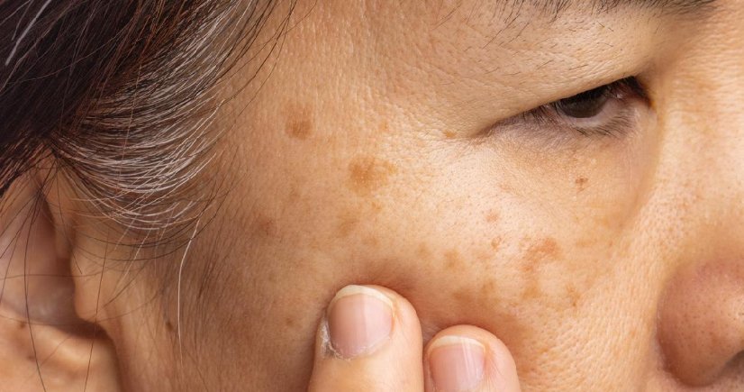 best melasma treatment in bangalore